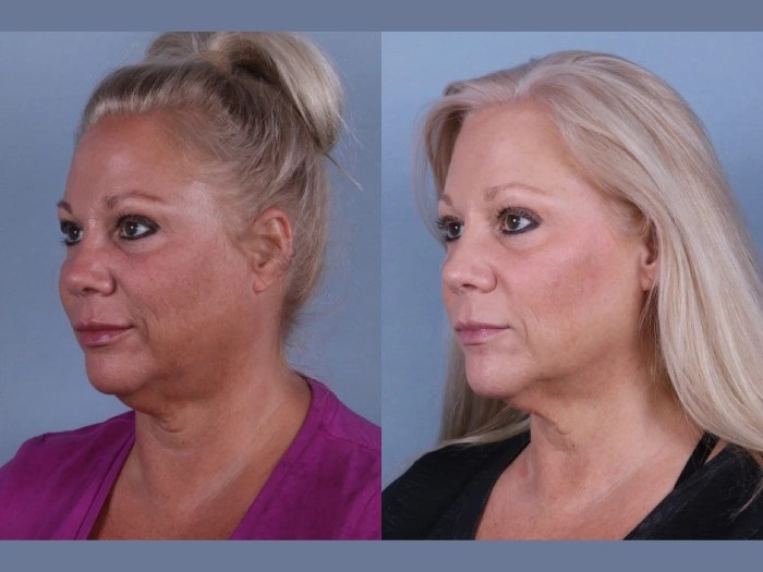 Cryolipolysis before after uae