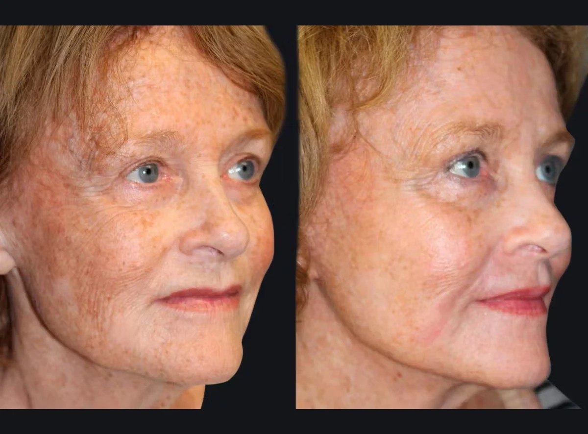 Laser Photo Rejuvenation before after dubai