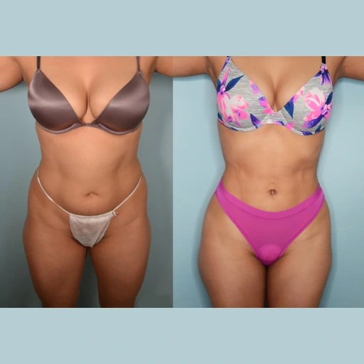 Liposonix Treatment in Dubai