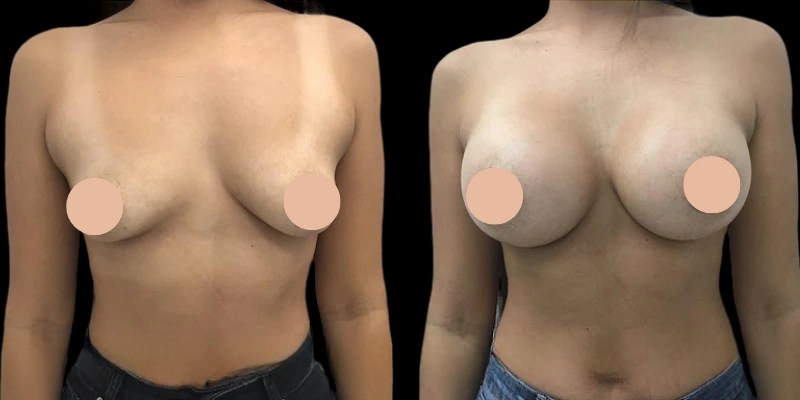 Mia femtech breast augmentation before after at perfect drs