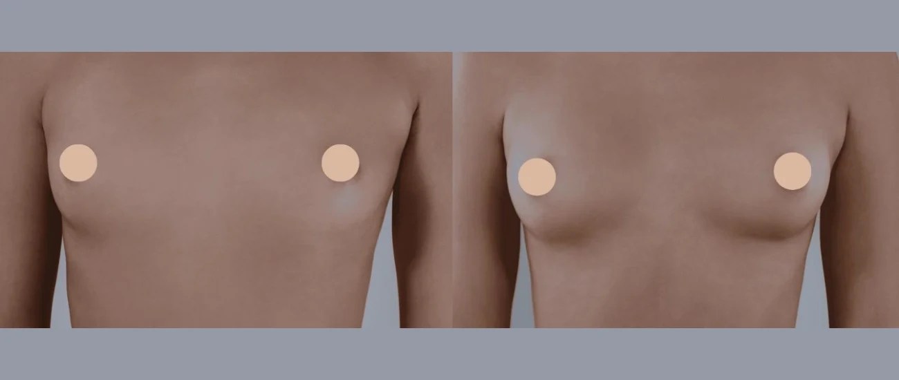 Mia femtech breast implants before and after