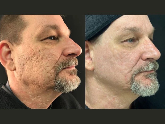 Radio Frequency for Acne Scars in Dubai