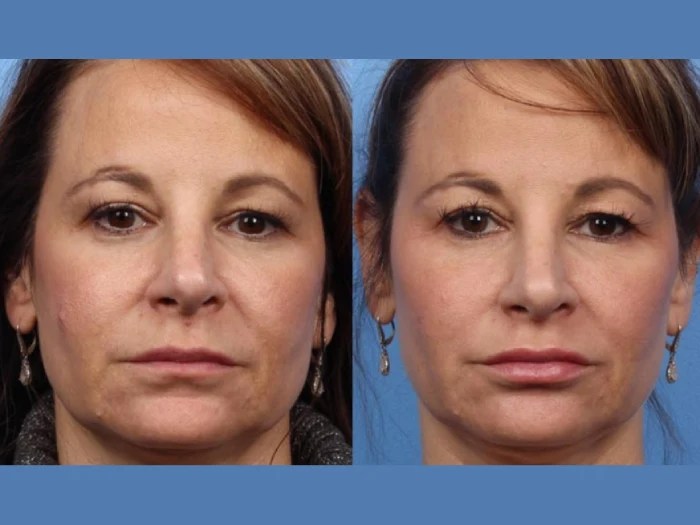 liquid facelift before after in dubai