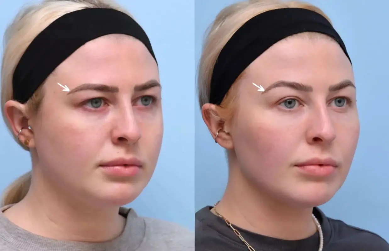 Botulax before after uae