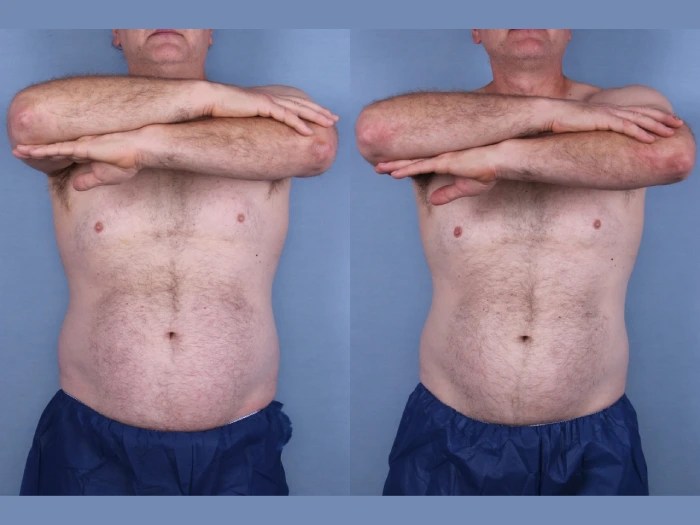 Cryolipolysis before after uae