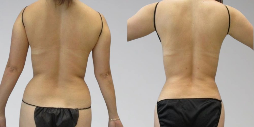 Lipolysis Injections in Abu dhabi