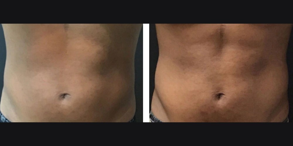 Trusculpt Flex Before After