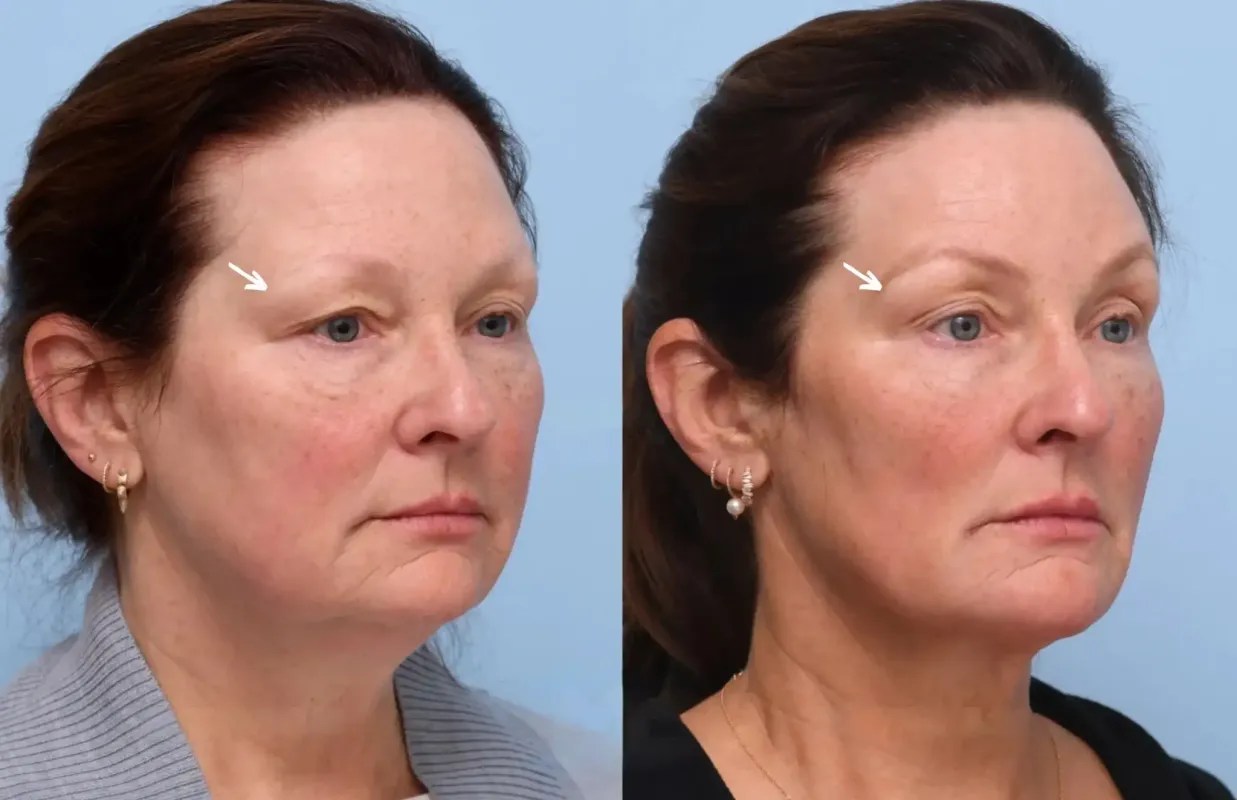 Botulax before after in abu dhabi