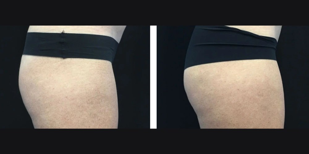 Trusculpt Flex in Dubai