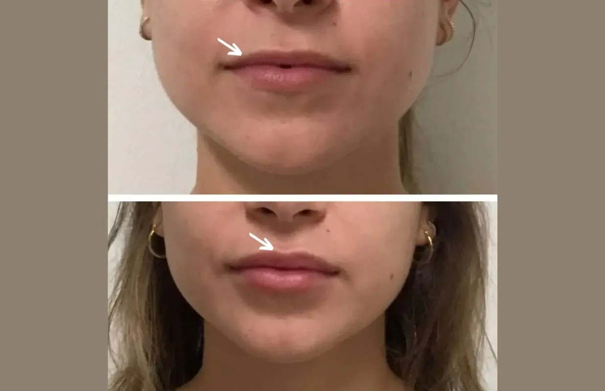 Botulax dubai before after
