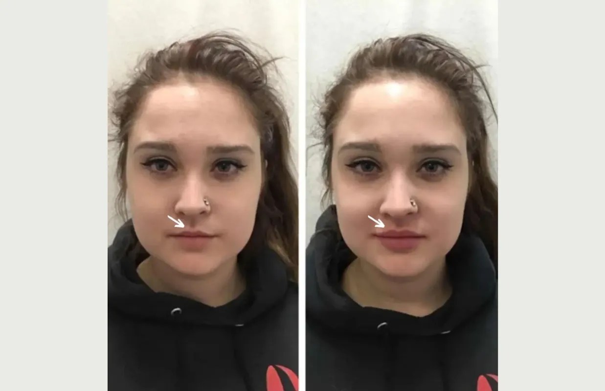 Botulax before after at perfect drs
