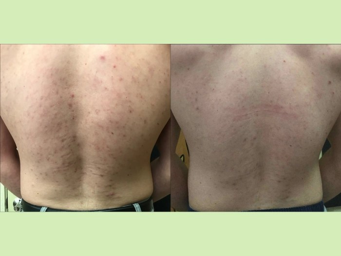 Pico Laser Before After Dubai