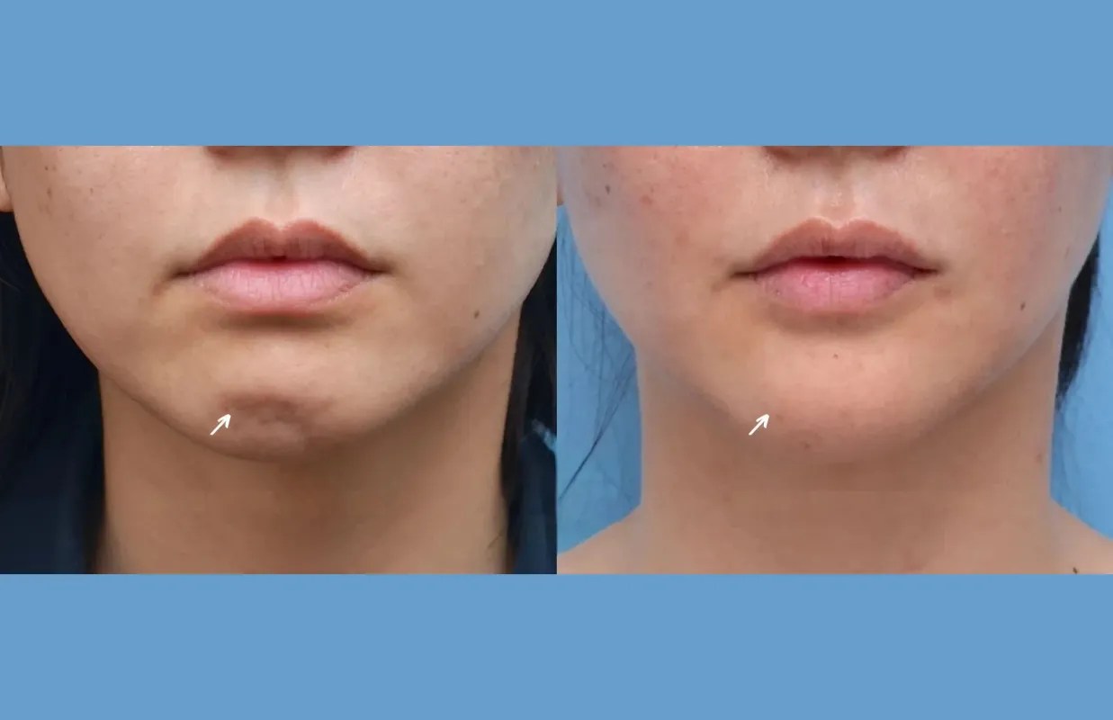 Botulax before and after