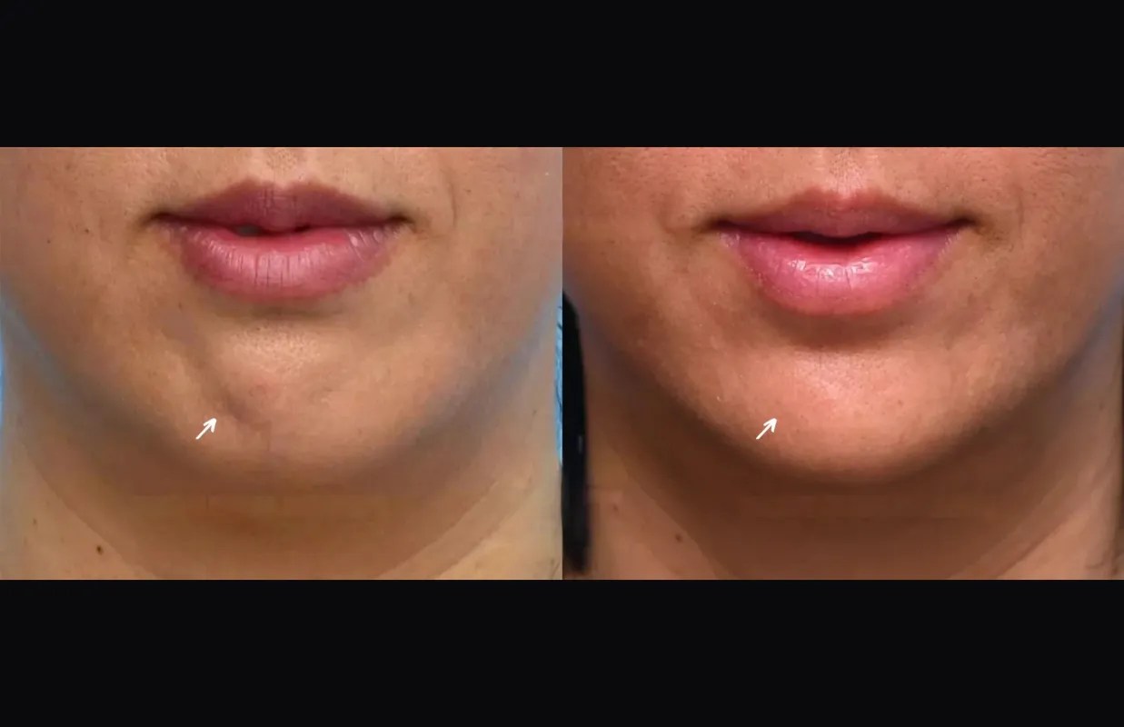 Botulax uae before after