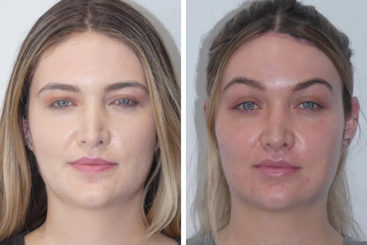 Botox Forehead Lift in Dubai