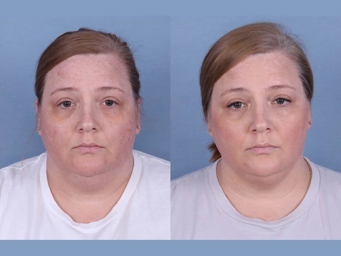 Cryolipolysis at perfect drs