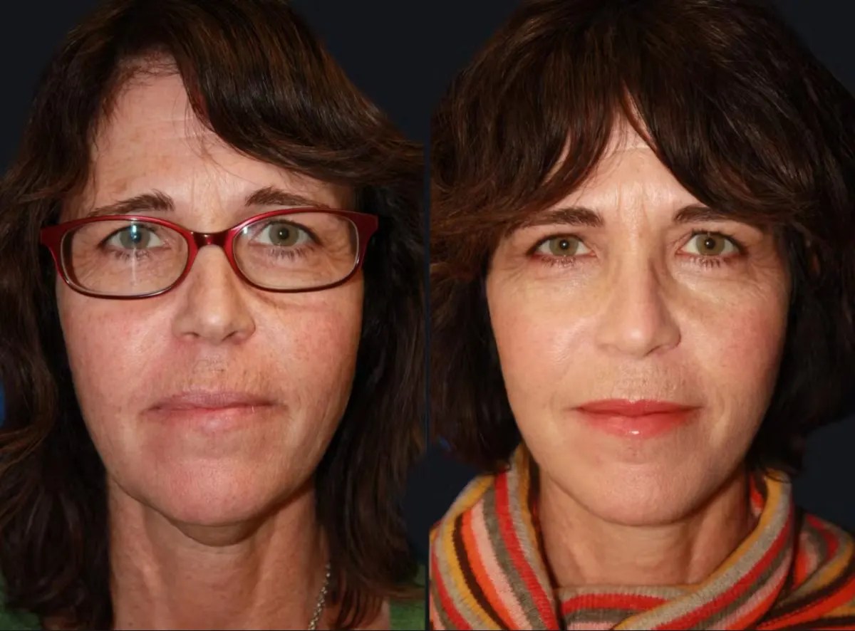 Laser Photo Rejuvenation in dubai