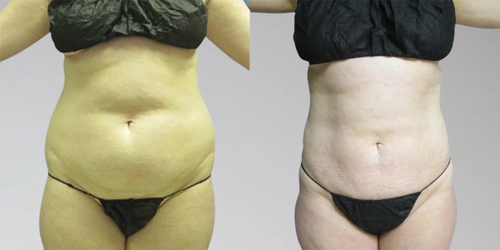 Lipolysis Injections before after uae