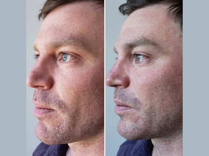 Male hydrafacial at perfect drs