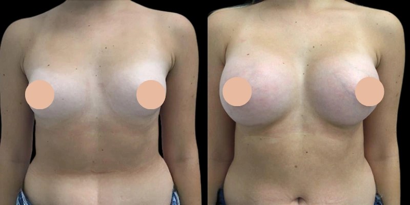 Mia femtech breast augmentation at perfect drs