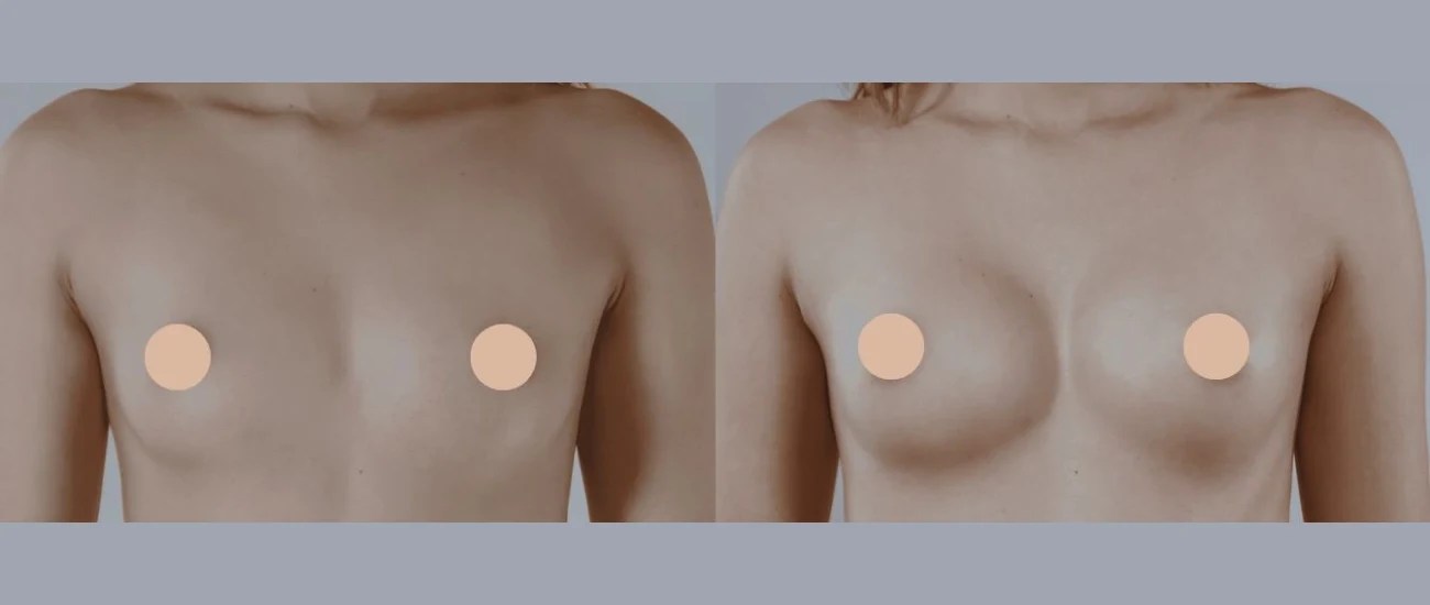 Mia femtech breast implants in dubai