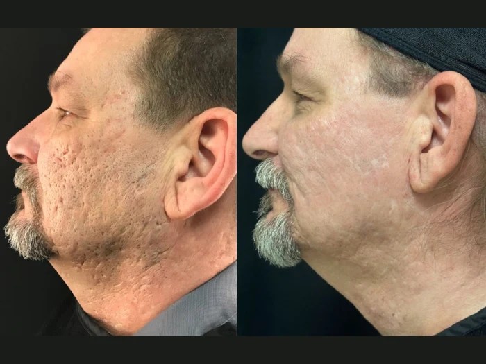 Radio Frequency for Acne Scars in uae