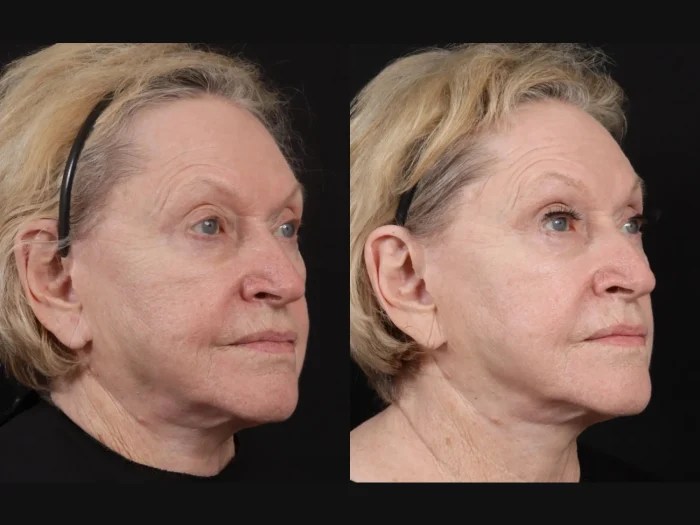 Secret Rf Microneedling Before After Dubai