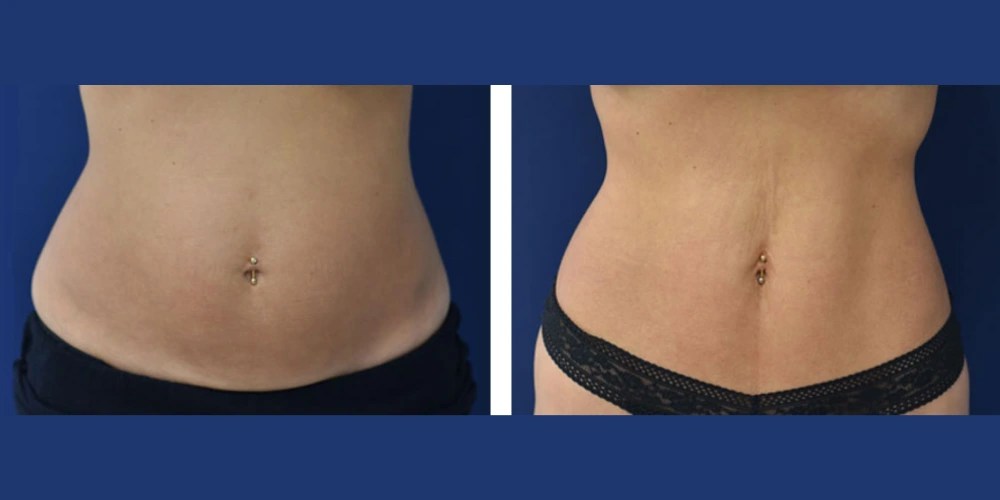 Trusculpt Flex in Abu Dhabi