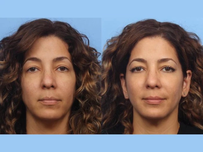 liquid facelift in abu dhabi