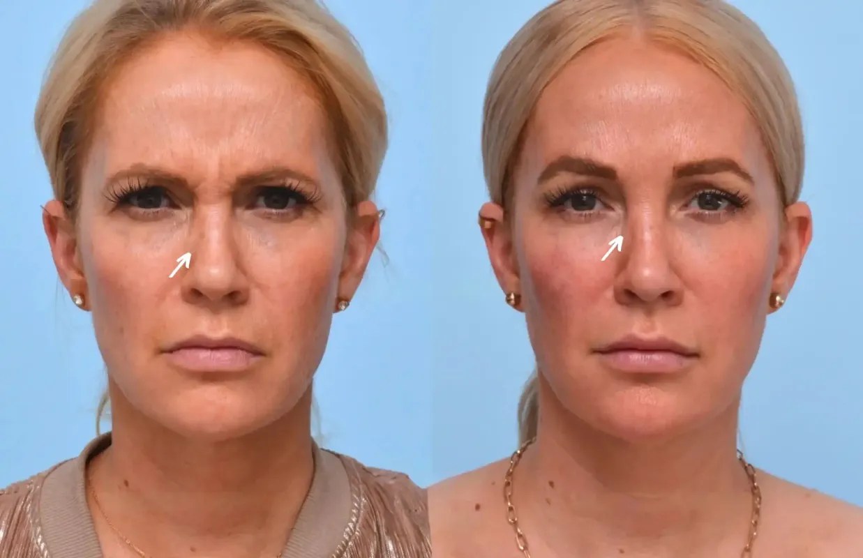 Botulax before after