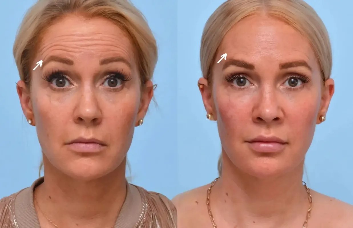 Botulax before after in dubai