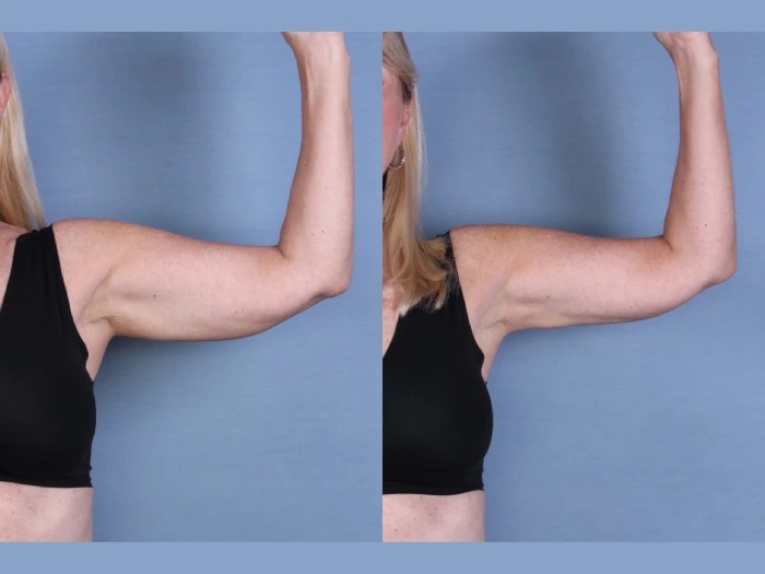 Cryolipolysis dubai before after