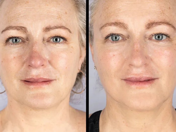 Led Light Therapy in Dubai