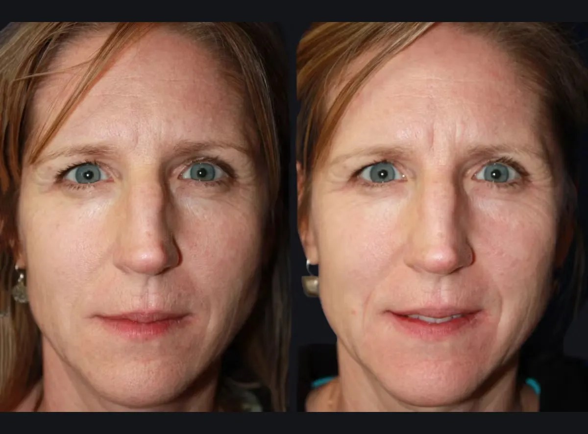 Laser Photo Rejuvenation before after