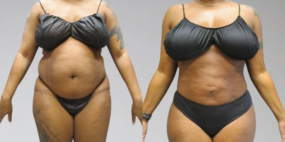 Lipolysis Injection In Abu Dhabi