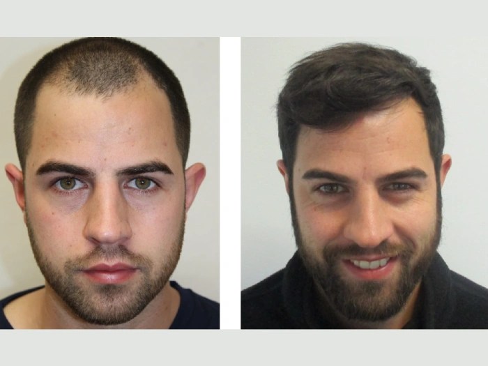 Mesotherapy for Hair in Uae