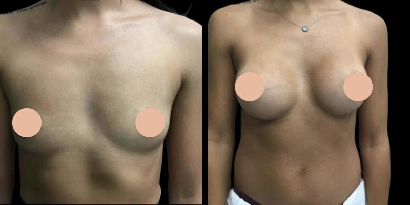 Mia femtech breast augmentation before and after in dubai abu dhabi