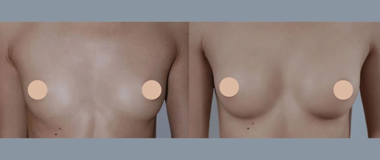 Mia femtech breast implants