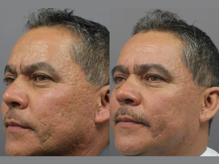 Radio Frequency for Acne Scars Abu dhabi before after