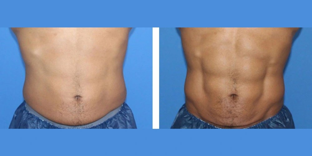 Trusculpt Flex in Uae