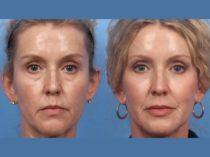 liquid facelift before after uae