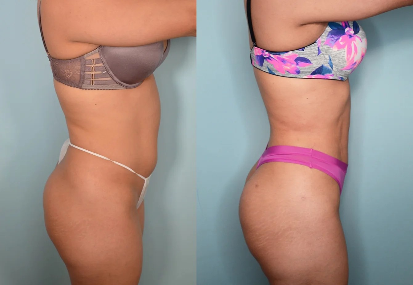 Microaire liposuction before after result in uae