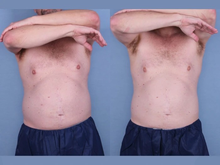 Cryolipolysis in Abu dhabi
