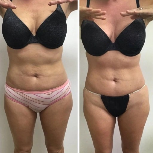 I-lipo in abu dhabi