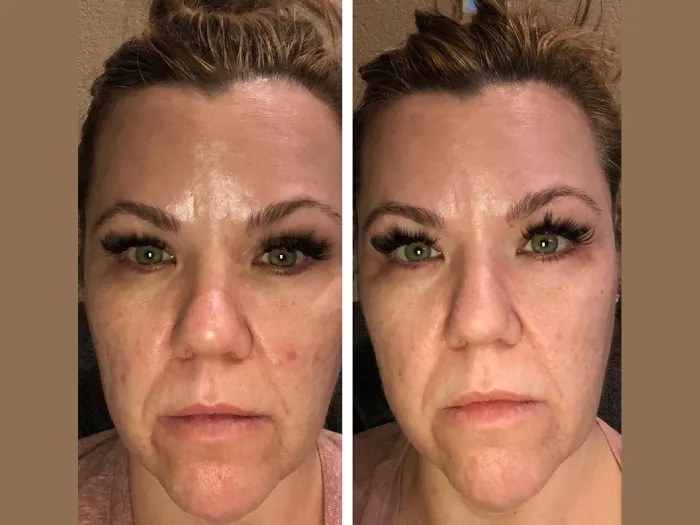 Led Light Therapy in Abu Dhabi