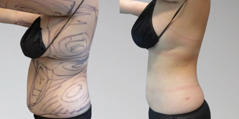Lipolysis Injections before after