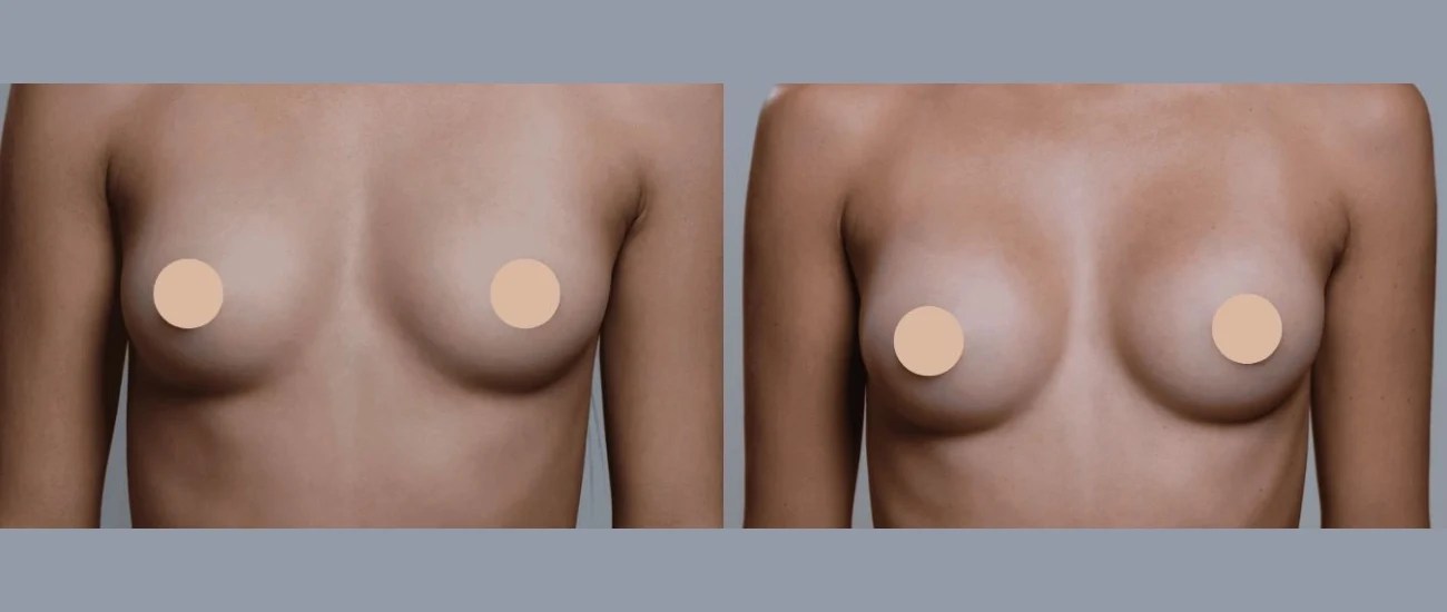 Mia femtech breast implants before and after in dubai abu dhabi