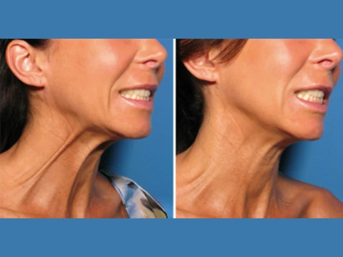 Nefertiti lift before after dubai