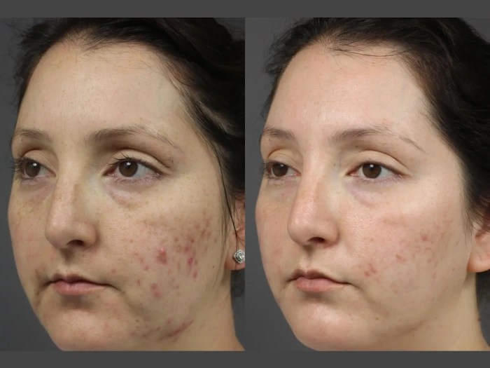 Radio Frequency for Acne Scars before after dubai