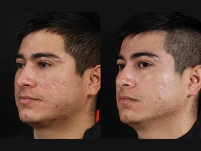 Secret Rf Microneedling at Perfect Drs